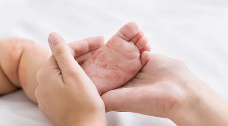 Measles: Twenty-six cases, and five outbreaks, confirmed in Ireland this year