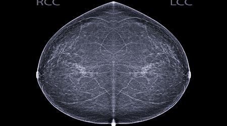 AI-driven mammography cuts workload by 33%, boosts breast cancer detection
