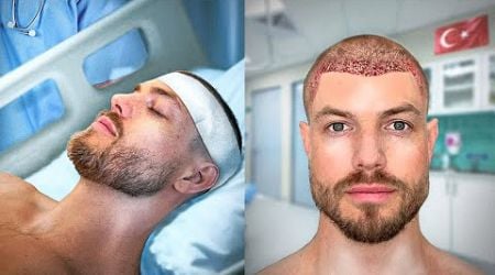 I Went To Turkey For Another Hair Transplant (4,800 Grafts)