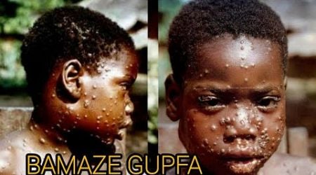 Munyuma mu Rwanda, habonetse ubundi bwoko bushya bwa Monkeypox - buri kwica kucyigero cyi 10%