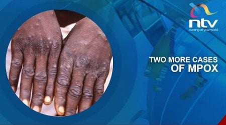 Kenya reports two new cases of Mpox in Mombasa and Kilifi