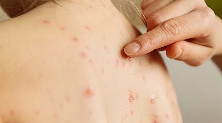 Chickenpox vaccine to be offered to babies at 12 months