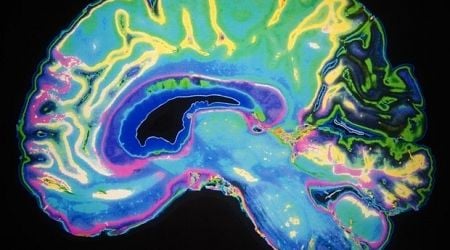 Study unravels the unique patterns of brain shrinkage in Alzheimer's disease