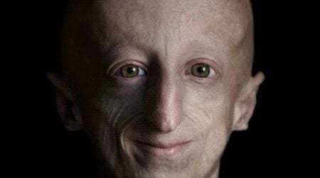 Connaissez-vous la progeria, cette maladie qui a eu raison du courageux Sammy Basso ?