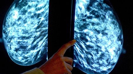 Hormonal coil may be linked to increased risk of breast cancer - study