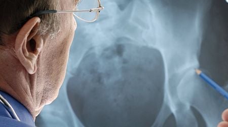 Up to 70% of osteoporosis patients getting inappropriate treatment, research finds