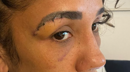 Amanda Serrano shows off battle wounds one week after Katie Taylor bloodbath