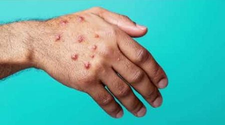 M pox (Monkeypox) Awareness: Symptoms, Prevention &amp; Global Impact #MpoxAwareness #Monkeypox