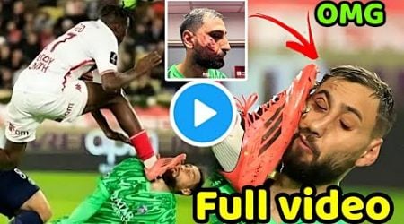 Gianluigi Donnarumma HORRIFIC FACE INJURY vs Monaco | Donnarumma injury update Donnarumma injury