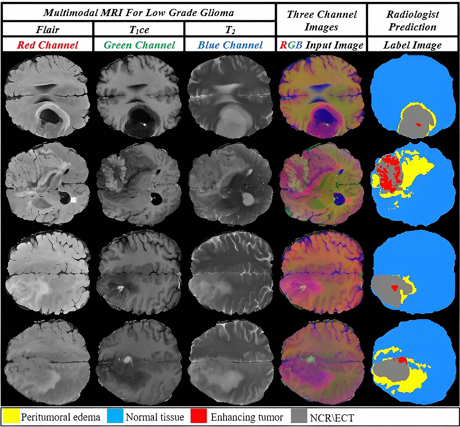 Quantitative and Visual Analysis of Data Augmentation and Hyperparameter Optimization in Deep Learning-Based Segmentation of Low-Grade Glioma Tumors Using Grad-CAM