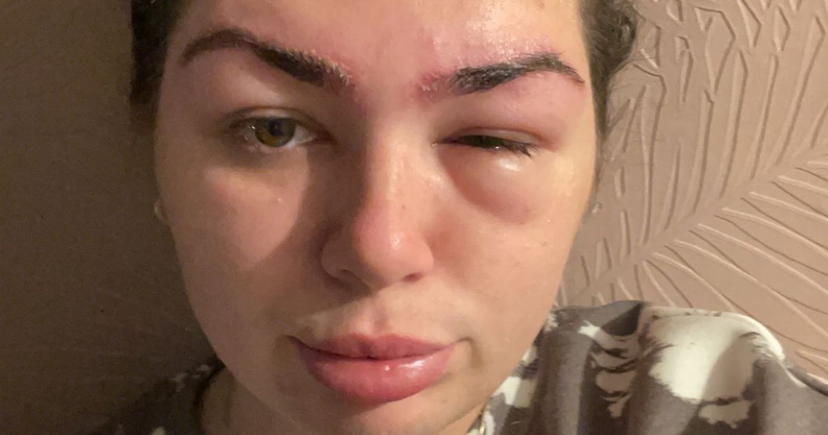 Woman left temporarily blinded in hospital after salon forgets to do allergy test on eyebrow tint