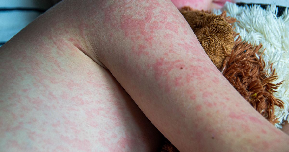 Twenty measles cases confirmed in Ireland this year with more under investigation
