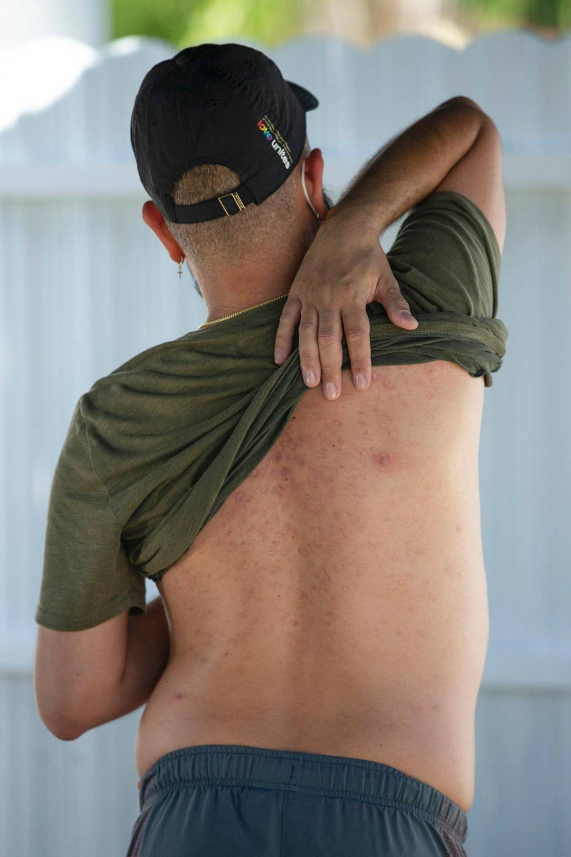 Is there a vaccine for mpox? Who can get the shot and where? How to find it in Florida