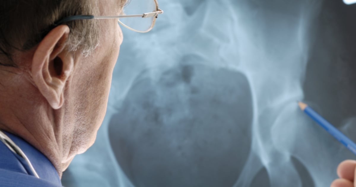 Up to 70% of osteoporosis patients getting inappropriate treatment, research finds