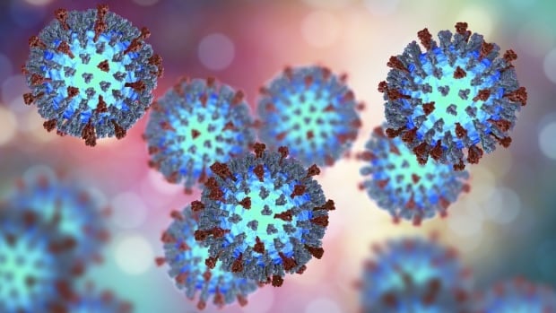 Public Health declares measles outbreak in western New Brunswick