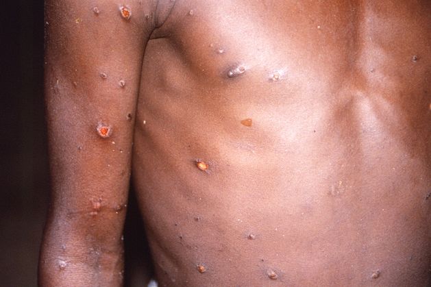 New monkeypox case in UK leads to calls for stronger detection measures