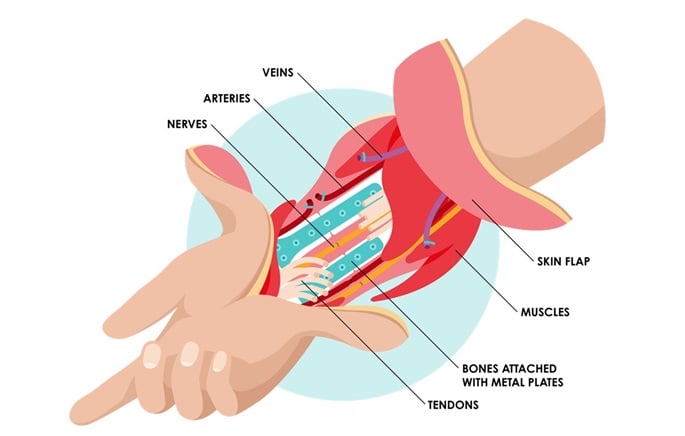 Finland performs 1st hand transplantation at HUS